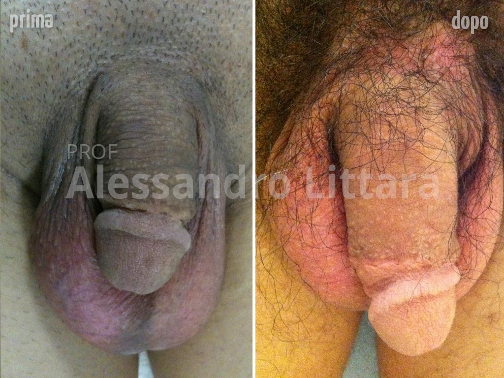 Allungamento del pene, Prima e Dopo
